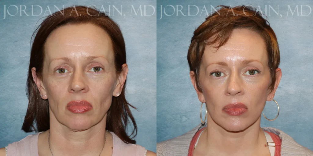 Facelift Before and After photo by Texas Facial Aesthetics in Francisco TX