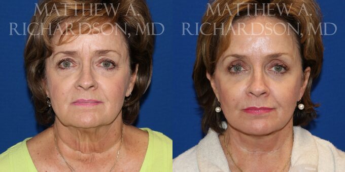 Facelift Before and After photo by Texas Facial Aesthetics in Frisco TX