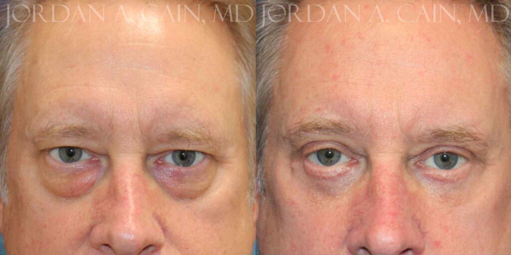 Blepharoplasty, Browlift, Fat Grafting, Laser Face Before and After photo by Texas Facial Aesthetics in Francisco TX