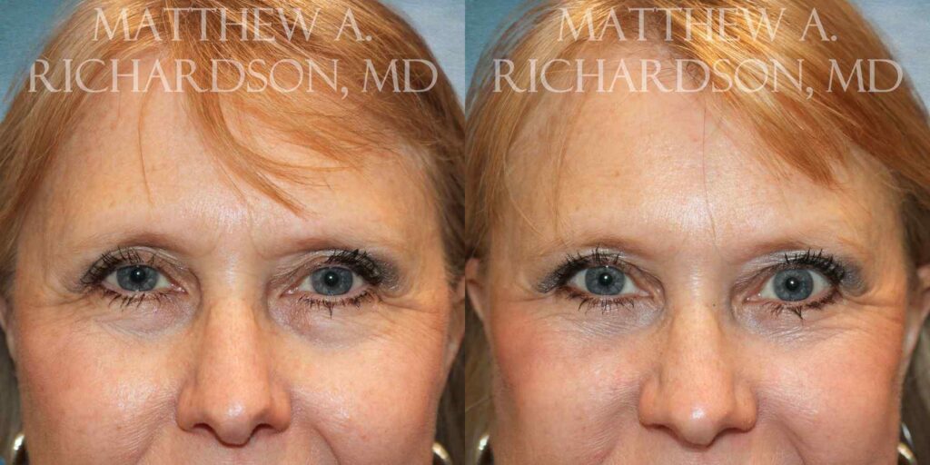 Eyelid Surgery Before and After photo by Texas Facial Aesthetics in Francisco TX