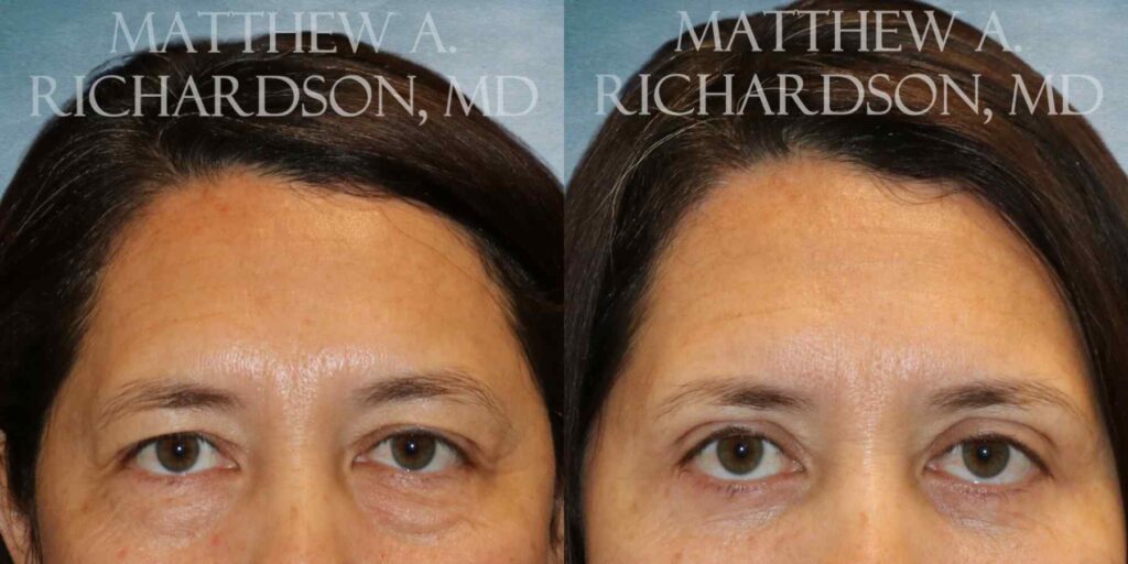 Blepharoplasty Before and After photo by Texas Facial Aesthetics in Francisco TX