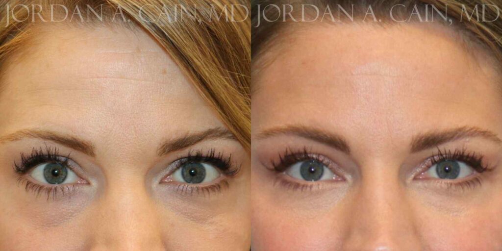 Blepharoplasty Before and After photo by Texas Facial Aesthetics in Francisco TX