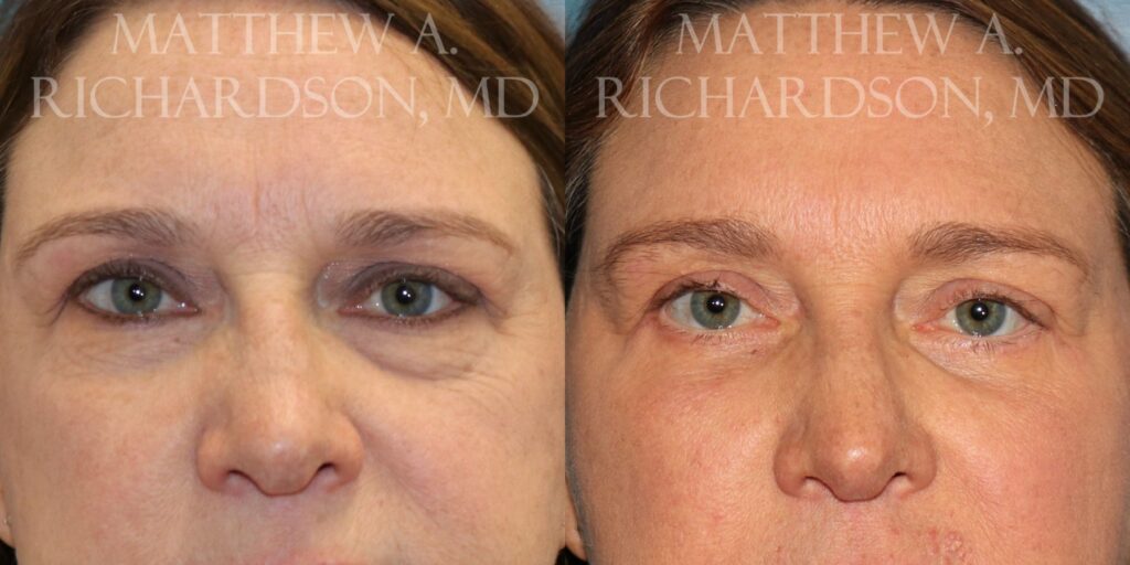 Blepharoplasty Before and After photo by Texas Facial Aesthetics in Francisco TX