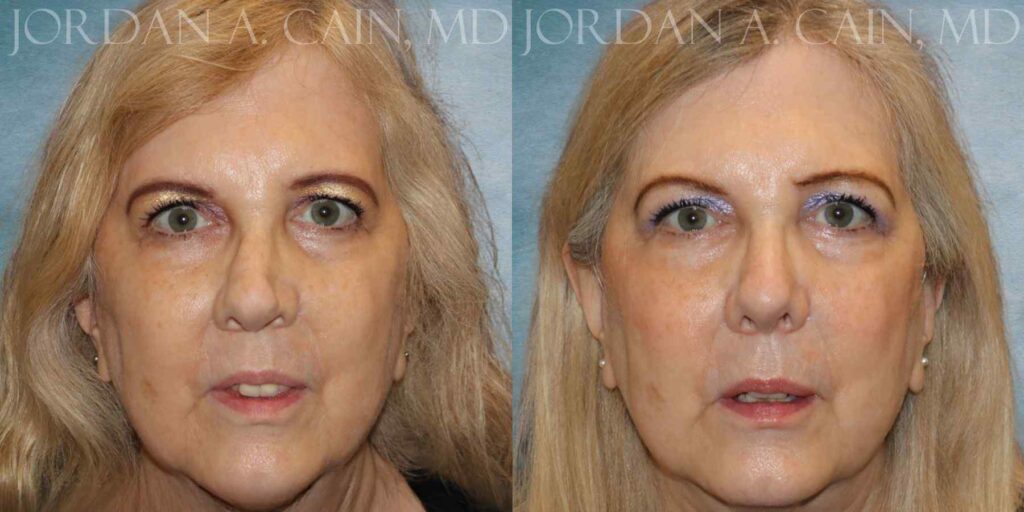 Septoplasty Before and After photo by Texas Facial Aesthetics in Francisco TX