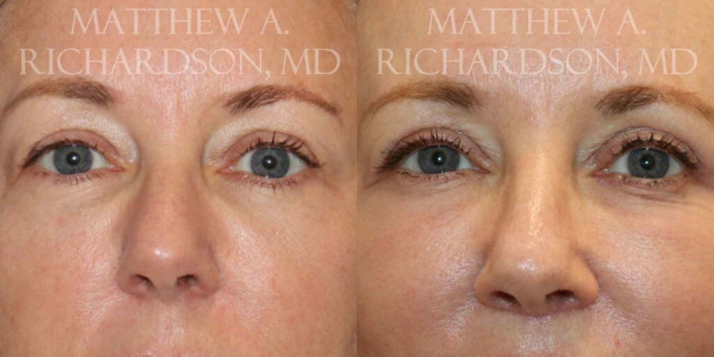 Blepharoplasty Before and After photo by Texas Facial Aesthetics in Francisco TX