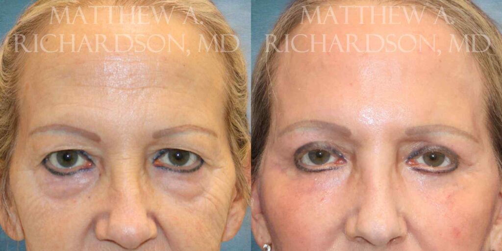 Blepharoplasty Before and After photo by Texas Facial Aesthetics in Francisco TX