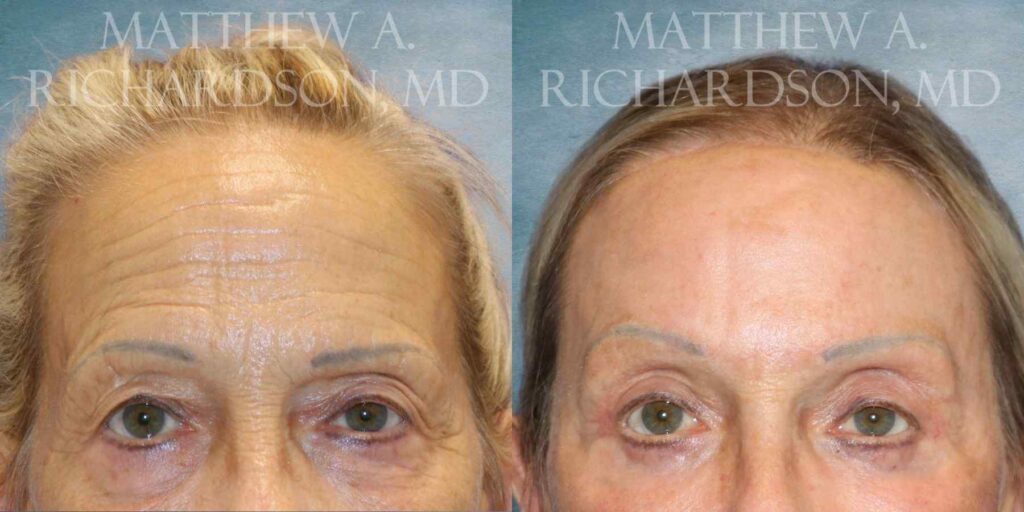 Brow Lift & Blepharoplasty Before and After photo by Texas Facial Aesthetics in Francisco TX