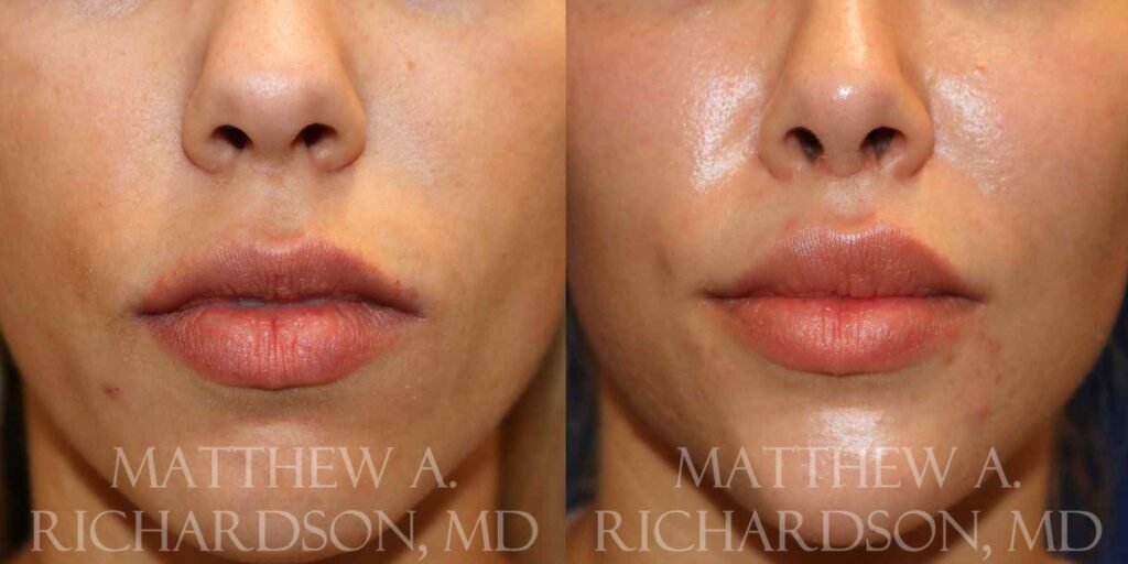 Lip Lift Before and After photo by Texas Facial Aesthetics in Francisco TX