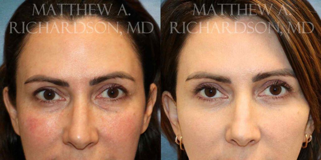 Blepharoplasty Before and After photo by Texas Facial Aesthetics in Francisco TX