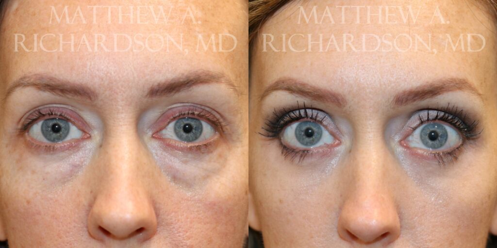 Blepharoplasty Before and After photo by Texas Facial Aesthetics in Francisco TX