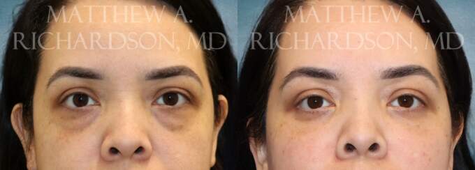 Blepharoplasty Before and After photo by Texas Facial Aesthetics in Francisco TX