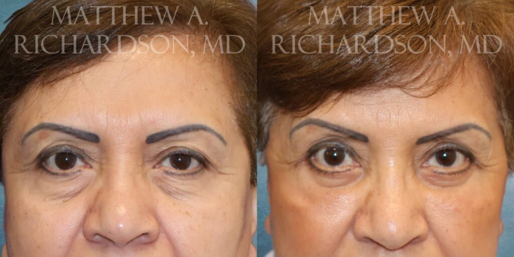 Blepharoplasty Before and After photo by Texas Facial Aesthetics in Francisco TX