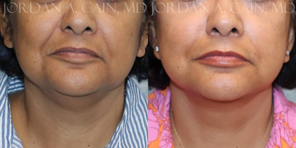 Facelift Before and After photo by Texas Facial Aesthetics in Francisco TX