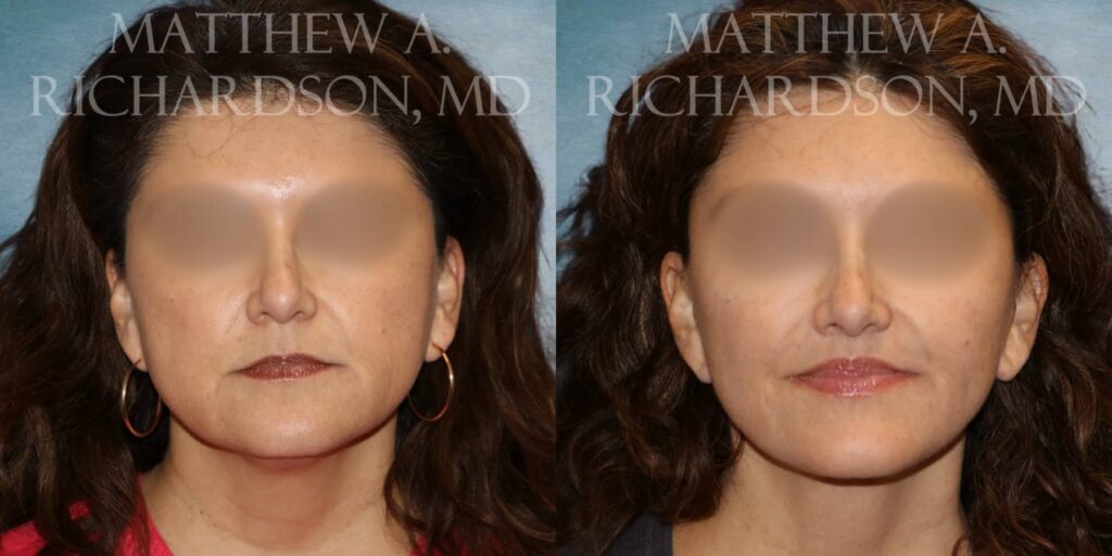 Facelift Before and After photo by Texas Facial Aesthetics in Francisco TX