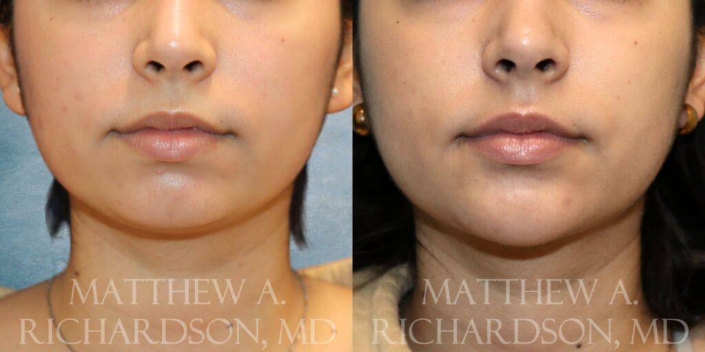 Chin Filler Before and After photo by Texas Facial Aesthetics in Francisco TX