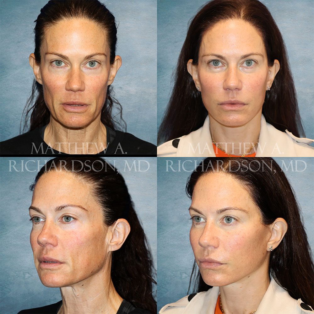 Facelift Before and After Photo Performed by Dr Matthew A. Richardson