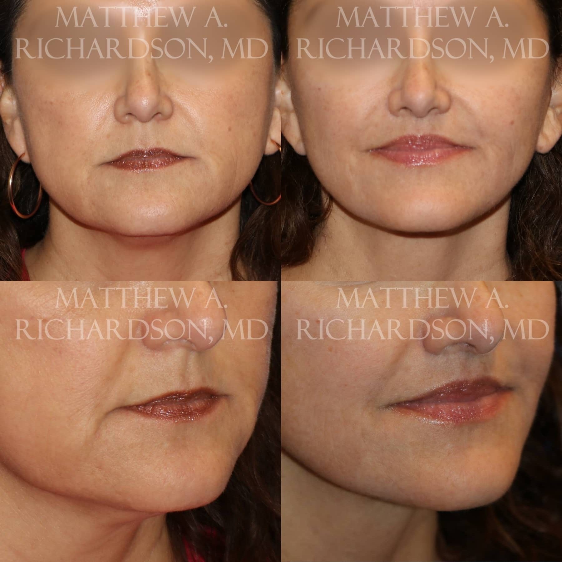 Lip Lift Before and After photo by Texas Facial Aesthetics in Francisco TX